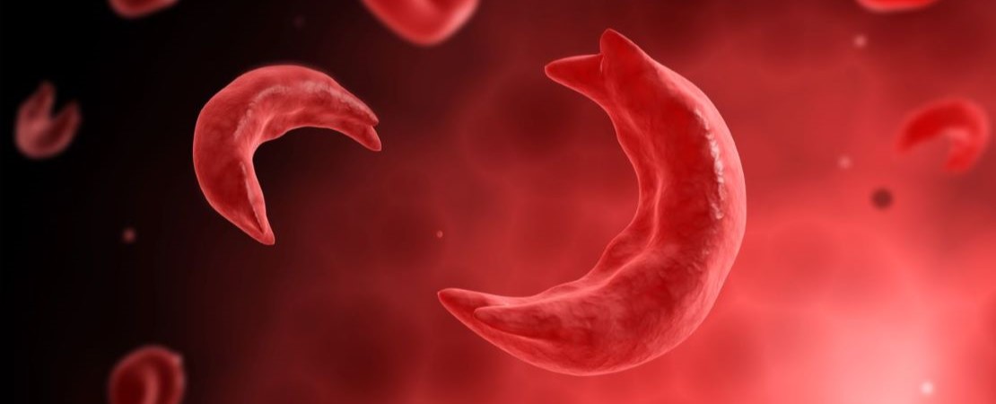 Sickle Cells