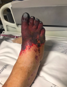 Gangrene Foot