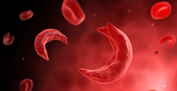 Sickle Cell Disease Workshop