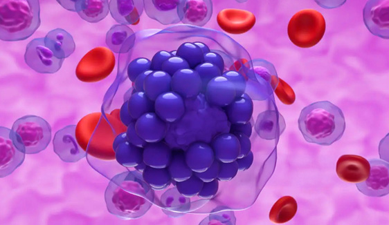 Lymphoma_Image_562x326