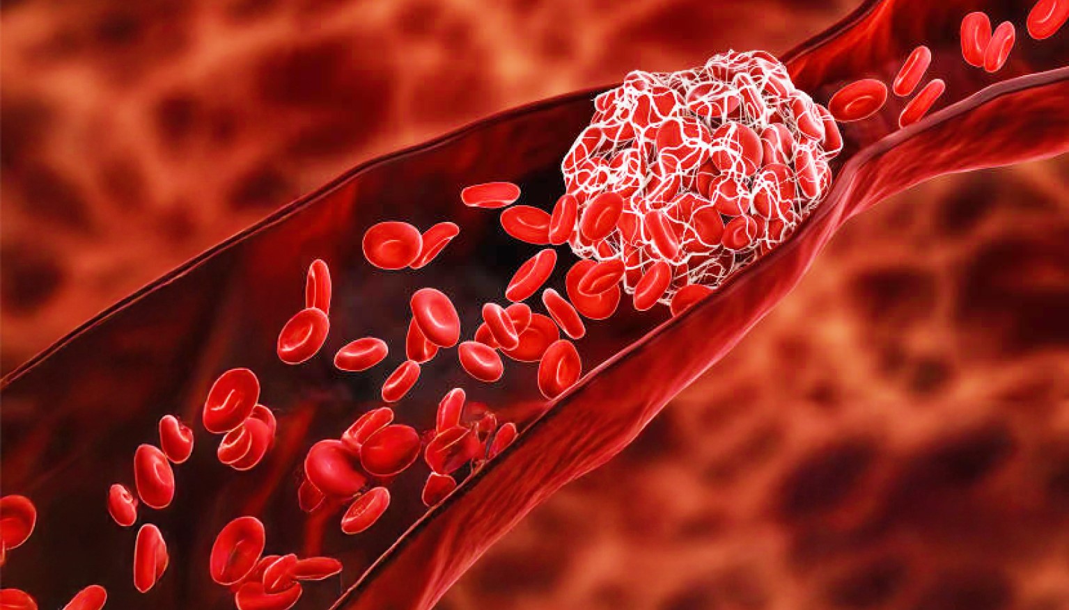 Graphic representation of red blood cells clotting in the artery.