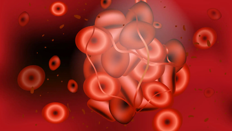 A photo of sticky red blood cells