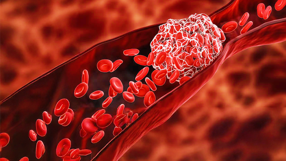 A photo depicting red blood flowing through veins, obstructed by sticky red blood cells.