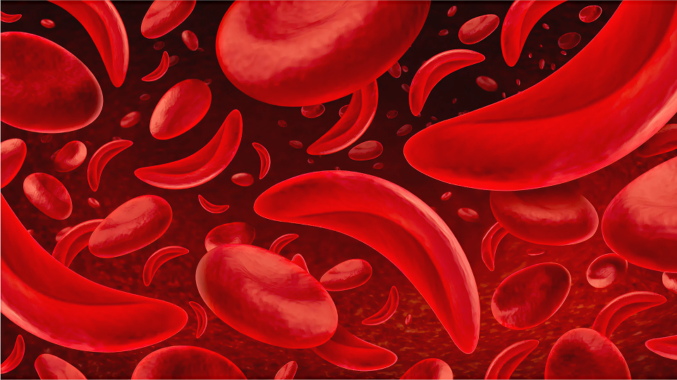 A photo illustration of sickle red blood cells flowing.