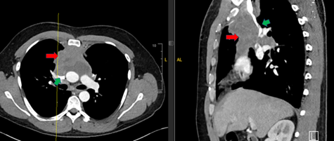 Green arrow: superior vena cava compressed by mediastinal mass. Red arrow: anterior mediastinal mass. Image used with approval from Icahn School of Medicine.