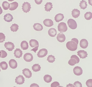 Peripheral blood smear at 100x