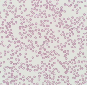 Peripheral blood smear at 50x