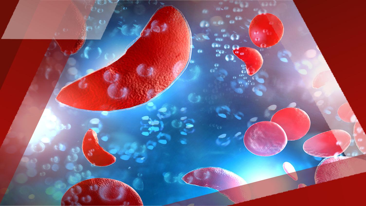 Advancing_Sickle_Cell_Card